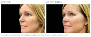 Exion Face for Non-Surgical Skin Tightening & Collagen Renewal in Bountiful Utah
